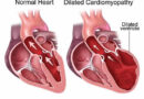 CUORE UNIVENTRICOLARE E COMPRESSIONI TORACICHE EFFICACI